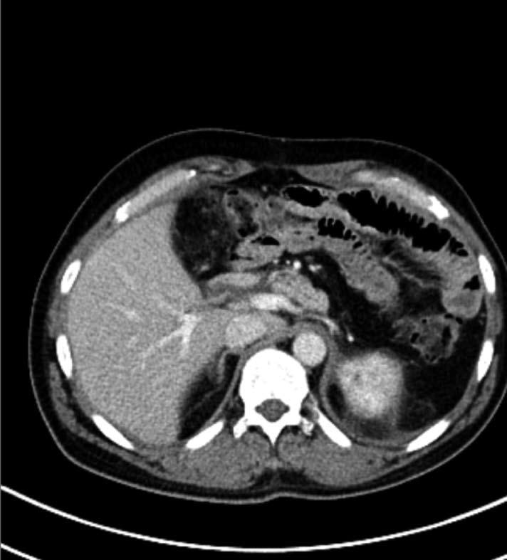 Coronal (A, B, C) contrast-enhanced CT images