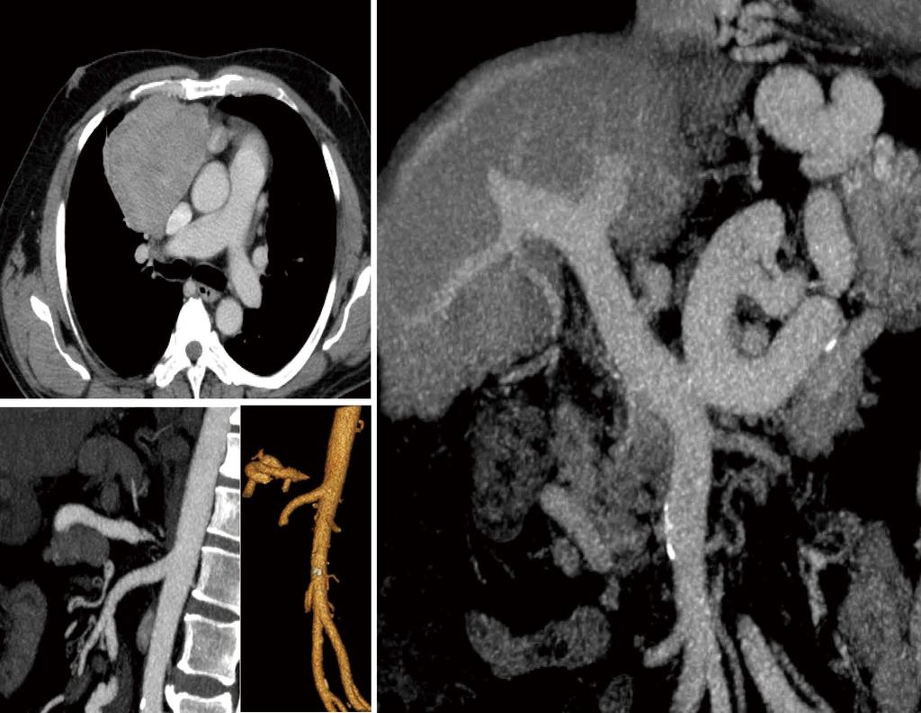 Martins GLP et al. RFA for hypersplenism A D * B C Figure 1 Axial, coronal and sagittal reconstructions of enhanced-computed tomography scan of the patient.