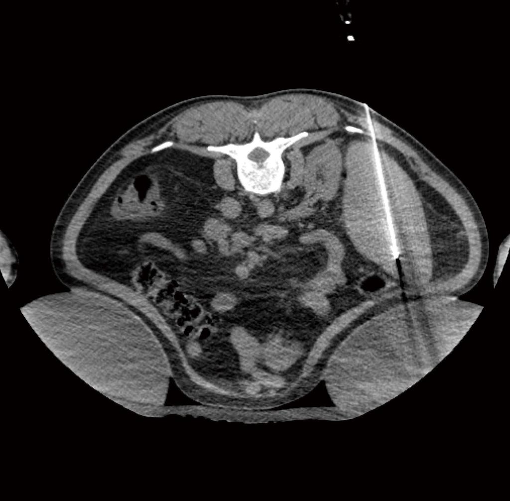 To reverse the thrombocytopenia to initiate chemotherapy treatment, the first option was splenic artery embolization, but this was contraindicated due to severe stenosis of the celiac trunk [arrows