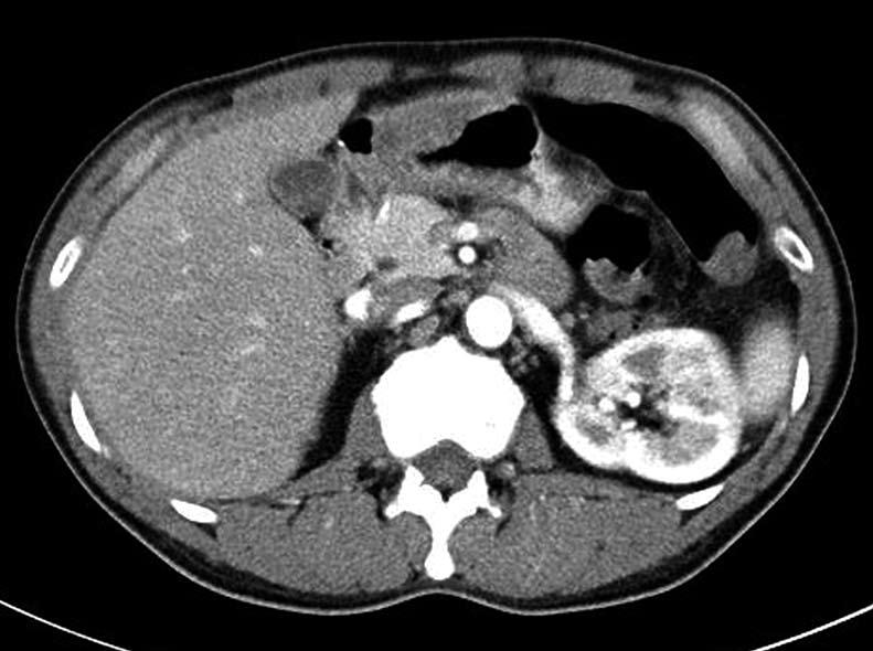 life-threatening. The rarity of gastric abscess may be associated with sufficient blood supply to the stomach and the bactericidal effect of gastric acid [1].