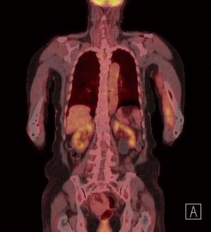 Jin SS et al. Gastrointestinal stromal tumor muscle metastasis A Figure 2 Positron emission tomography-computed tomography.