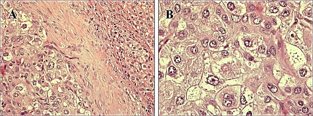 Figure 5: A) Hepatocellular carcinoma in tyrosinemia B) tumor cells Once the diagnosis of tyrosinemia type I is established from blood and urine studies, liver imaging is performed on a routine,