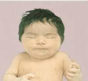 growth retardation Infancy hypothyroidism