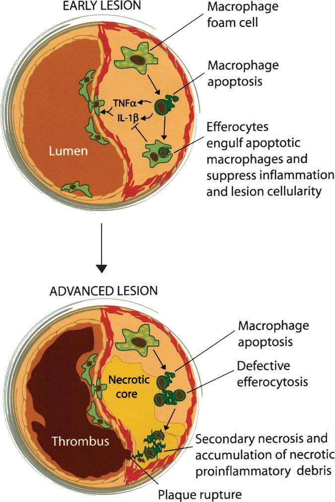 Atherosclerosis- Role of the Macrophage Macrophages are a key cell type involved in atherosclerosis-lipid accumulation, inflammation, efferocytosis Efferocytosis- In early atherosclerotic lesions-