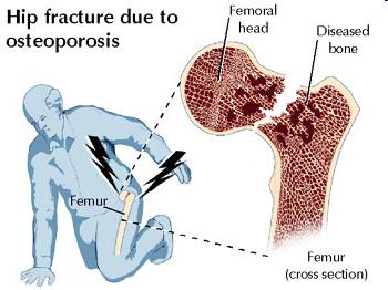 Worldwide Public Threat Osteoporosis afflicts an estimated 1/3 of women aged 60 to 70, and 2/3 of women aged 80 or older; approximately 200 million women worldwide suffer from osteoporosis.