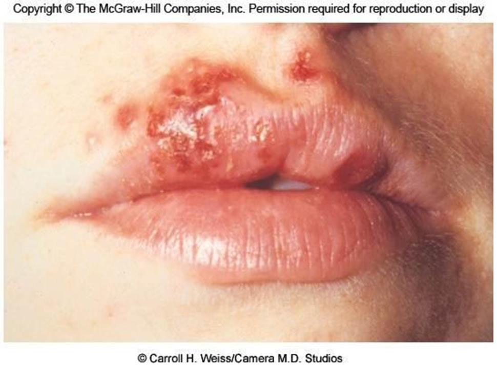 Herpes Infections Herpes type 1 ( Fever blisters or Cold sores): Infection in the skin or mucus membrane of the mouth and lips Caused by