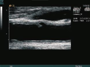 Ulcerative plaque and interruption of the intimal surface of this carotid artery