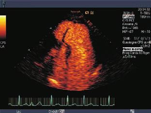 contrast agent Harmonic imaging and color Doppler sensitivity with the 4V1c