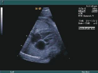 Pediatrics/Fetal Color M-mode of transmitral forward flow and holosystolic