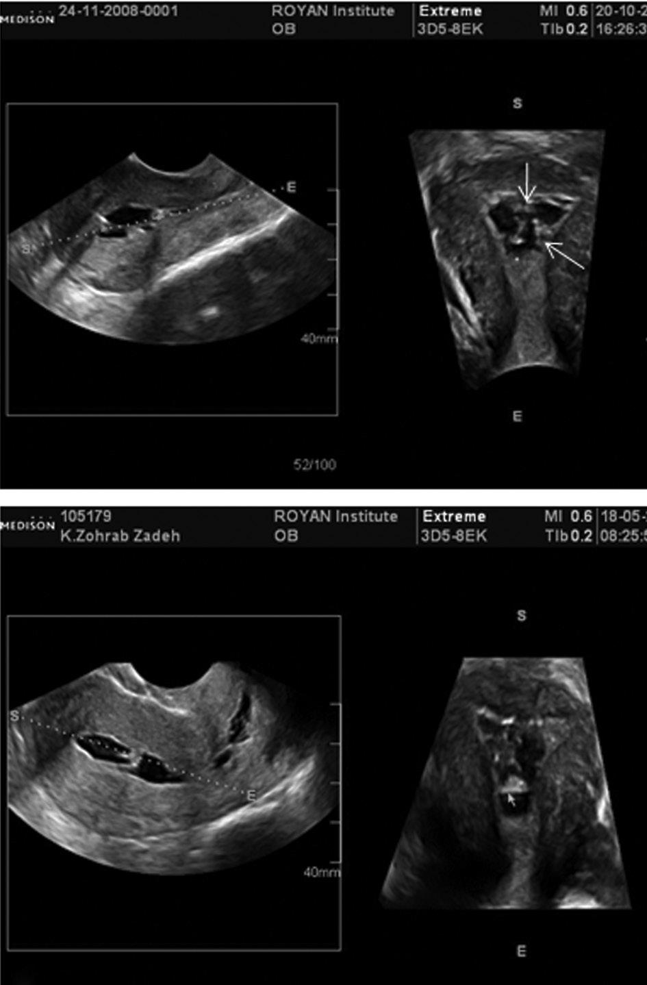 3DXI Sonohysterographic Evaluation of Intracavitary Pathologies Endometrial hyperplasia may be suspected sonographically.