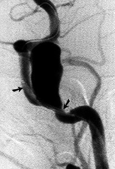 Fig. 1. Digital subtraction angiogram, oblique projection, revealing a giant aneurysm at the junction of the petrous and cavernous portion of the ICA.
