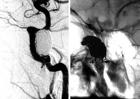 Fig. 2. Left: Following stent deployment and GDC placement, a dense coil mass is visible within the aneurysm.