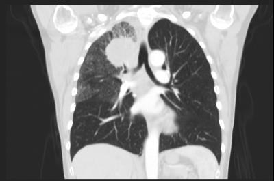 53yr old female Locally advanced NSCLC Clinical case Presented with right facial pain, no respiratory symptoms V20 33.