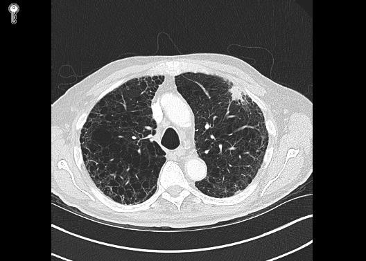 78 yr old male Chest infection CXR LUL lesion PMH COPD, emphysema, MI, ex smoker 52 pack year history WHO PS=2, MRC RS 3 FEV1 32% predicted KCO 36% predicted PETCT- LUL