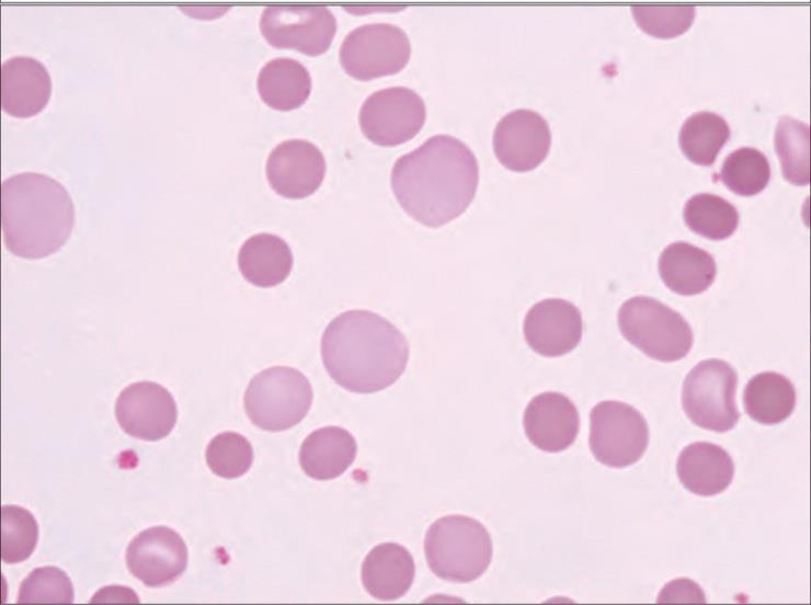 This small amount of free hemoglobin that reached the blood is enough to cause low haptoglobin level but it is not enough to cause hemoglobinemia and hemoglobinuria. 4.