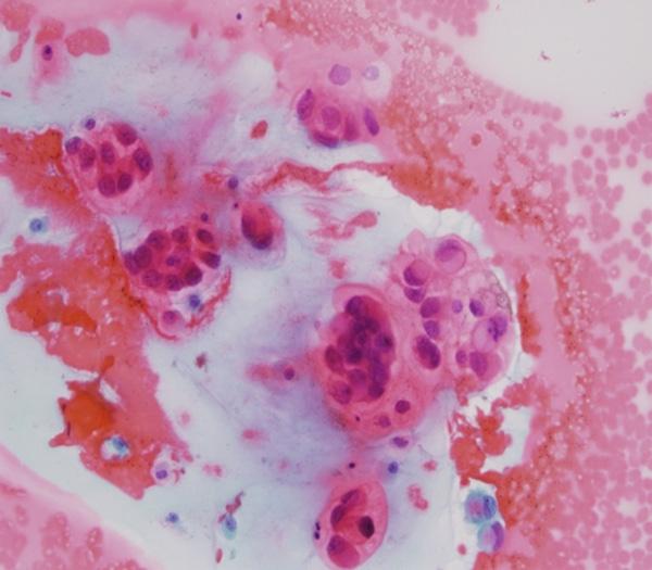 Figure 1. Pap smear. Paget tumor cells exist individually or arranged into clusters and nests.