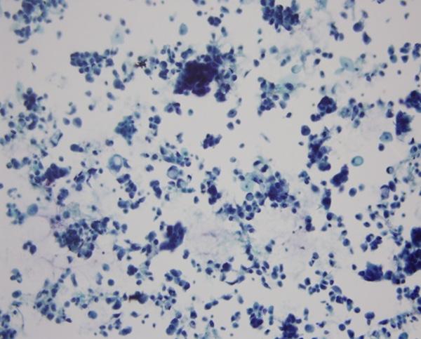 The cytoplasm of most tumor cells is abundant, light stained, and clear with an irregular edge and often contains vacuoles of varying size. Some tumor cells are signet ringshaped. 400. Figure 3.