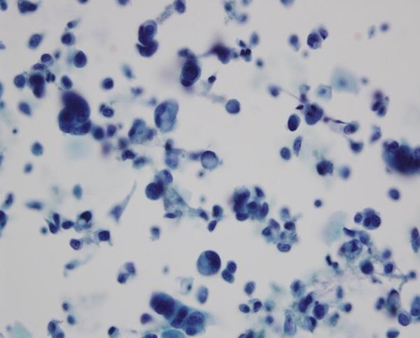 Nuclei are dark and often have nuclear vacuoles. 400. Figure 2. Vaginal fluid-based cytology test (LCT). Inflammatory infiltration of neutrophils and lymphocytes are observed in the smears.