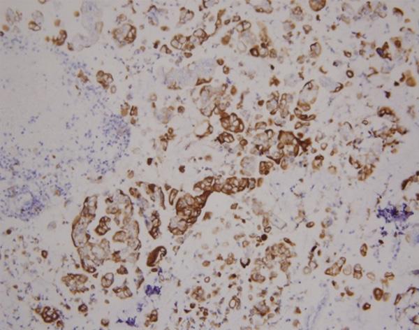 Figure 5. Immunohistochemistry showed the Paget cells are positive for CK7. DAB 200. Figure 7. Invasion of Paget tumor cells is observed in the epidermis of perianal EMPD.