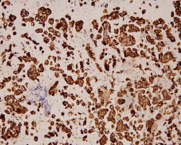 In some neoplastic cells, the nucleus is peripheral and cells are signet ring-shaped. HE 400. abundant and light staining.