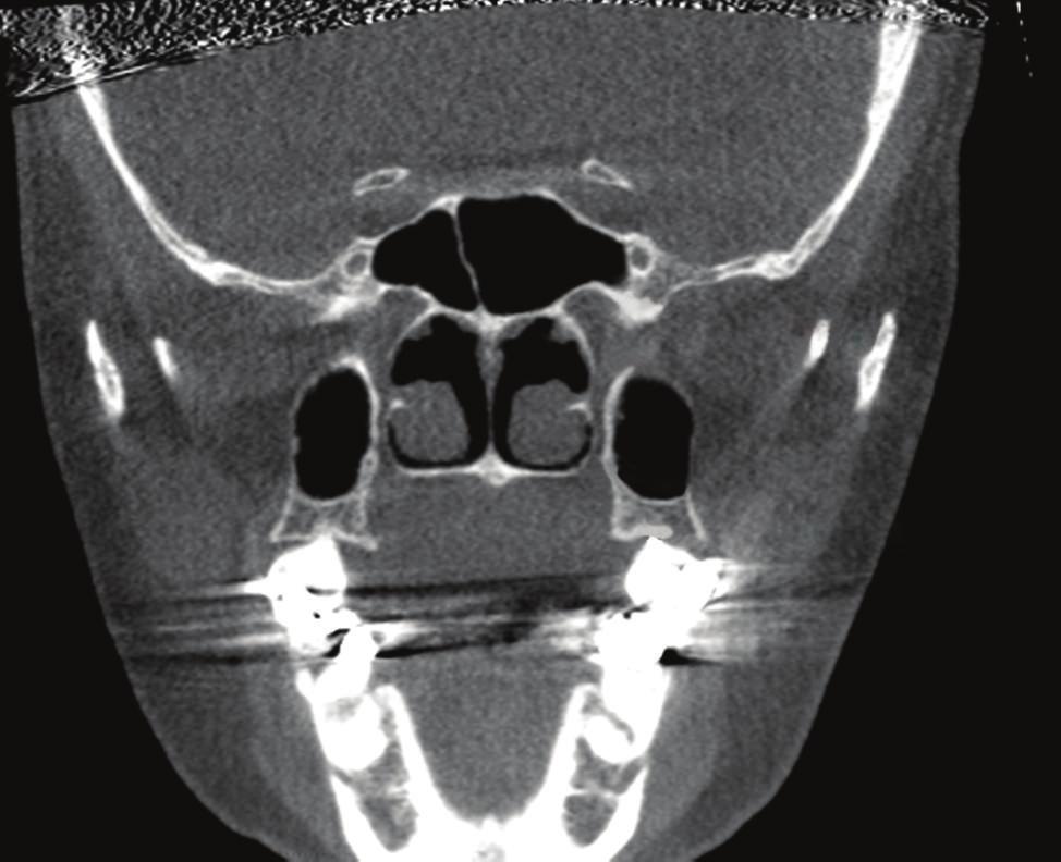 International Dentistry 3 Pterygopalatine fossa Pterygoid canal Pterygopalatine fossa Greater palatine foramen Greater palatine foramen (a) (b) Figure 1: The images above demonstrate the appearance