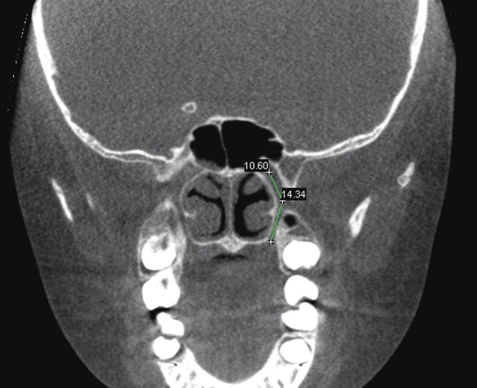 the pterygopalatine fossa to the inferior surface of the horizontal hard palate.