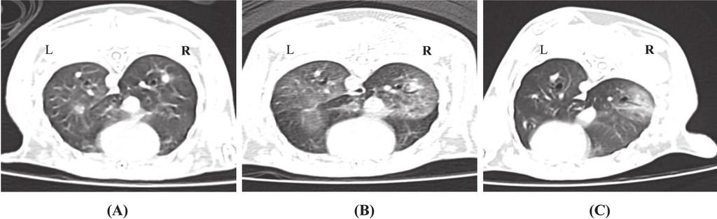 TIO 2 AND EOSINOPHILIC LUNG INFLAMMATION 291 Fig. 1. Lung inflammatory change by chest CT image analysis.