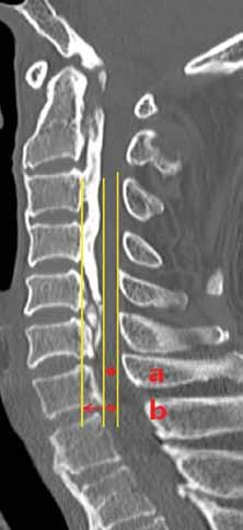 only operated cases. To our knowledge, no study has reported on the analysis of OPLL patients without myelopathy.