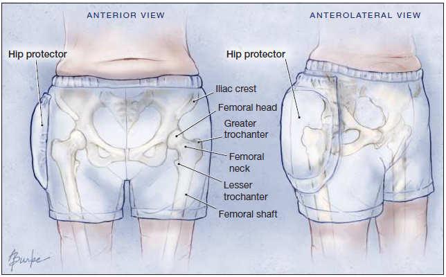 effectiveness of hip protectors in frail older people in institutional care.