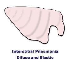 Pleural adhesions Fibrinous Pleuritis 17 18 INTERSTITIAL PNEUMONIA Diffuse or