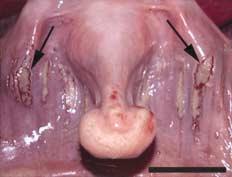 Post-mortem Findings in Harbour Porpoises 5 Fig. 4. Large skin ulcer on the caudal peduncle extending into muscles. Bar, 8 cm. Fig. 5. Dorsal view of larynx: acute ulcerative oesophagitis; ulcers (arrows) covered by fibrinous membranes.