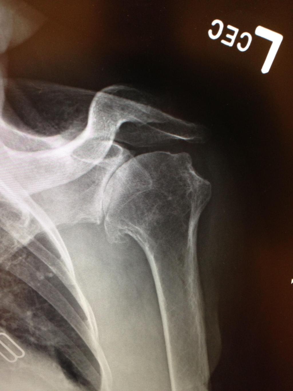 SHOULDER SERVICE TOTAL SHOULDER REPLACEMENT The following is