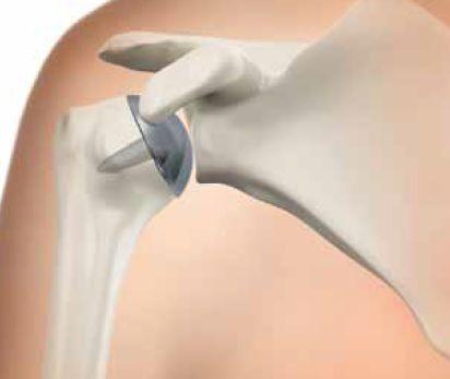 WHAT IS SHOULDER RESURFACING? An option for some patients is shoulder resurfacing.