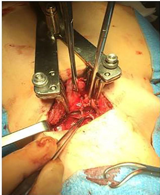 visible); (D) the thymus is resected along with mediastinal fat tissue; (E) the surgical specimen. a median follow-up of 5 years, the median preoperative Osserman grade (14) improves from 3.0 (mean 2.