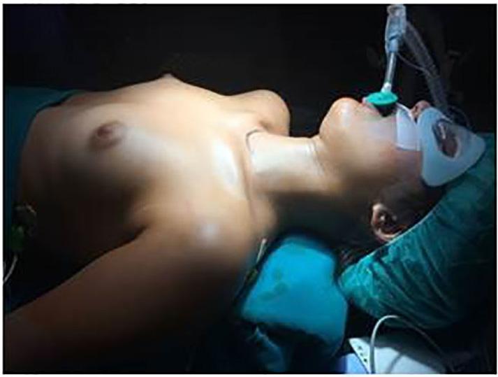 Extended thoracoscopic thymectomy Tomulescu and Popescu (17) firstly proposed a thoracoscopic unilateral extended thymectomy (TUET), with the aim to proceed with the rigorous resection of all thymus