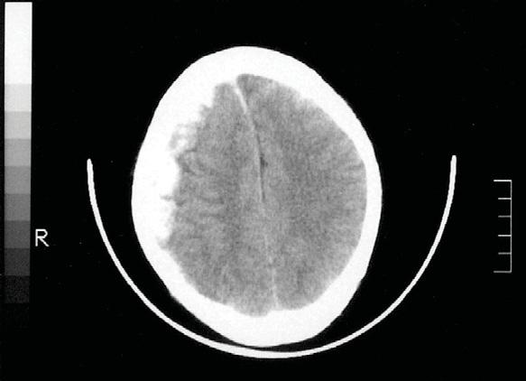 Hypopituitarism after traumatic brain injury Posttraumatic hypopituitarism is an uncommon disease.