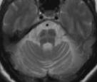 and lesions of the cerebellum Severe ponto-cerebellar atrophy in