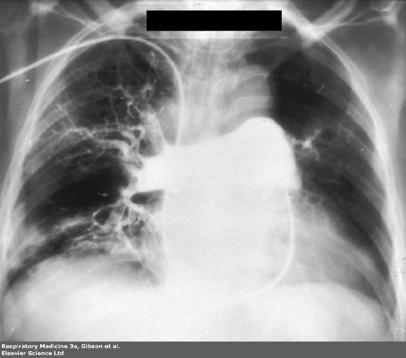 PE Diagnosis : Pulmonary Angiography Pulmonary