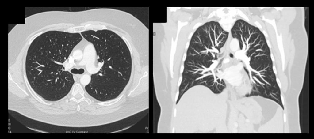 A B Figure 1. CT Thorax (A Axial, B Coronal) showing mild main pulmonary artery dilatation, normal intrapulmonary vessels with no peripheral dilatation. Table 1.