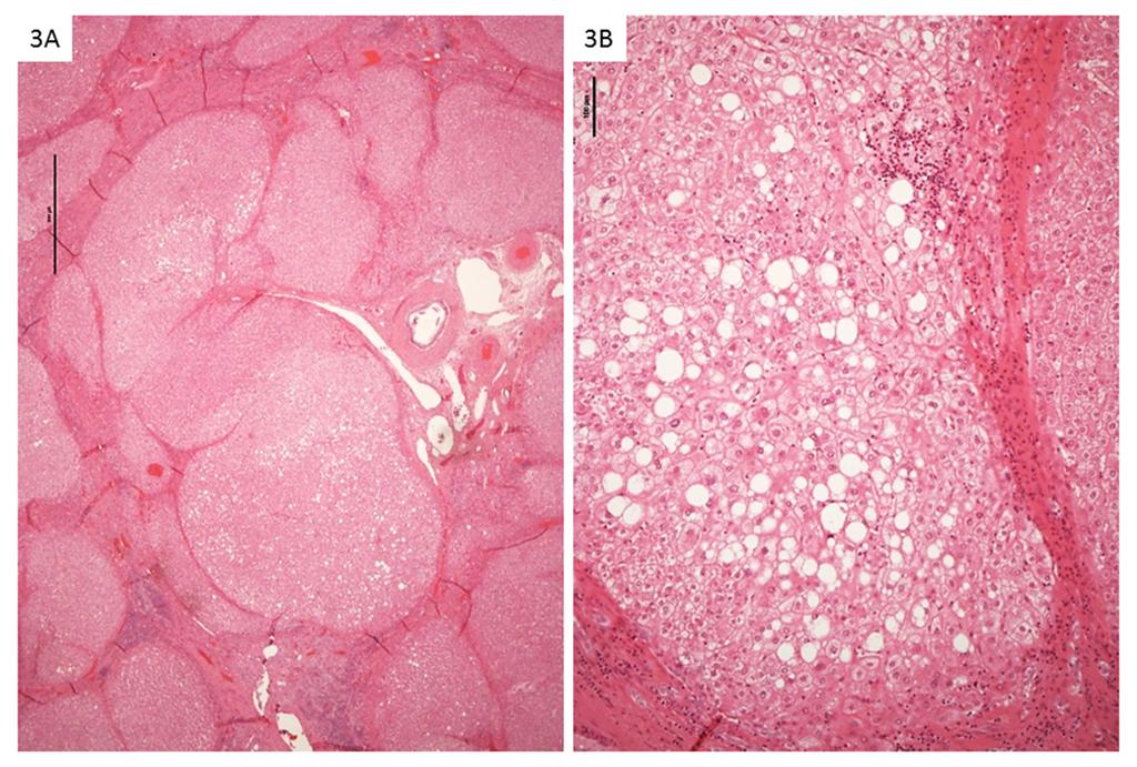 A B Figure 3. Histology of the explanted liver show cirrhosis (A) and steatosis (B) (hematoxylin and eosin stain, magnification 20 (A), 100 (B), scale bar 1000 µm (A) and 100 µm (B)).