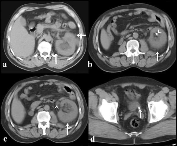 E. Ogreden, U. Oğuz, E. Demirelli, E. Benli, Ö. Özen Figure 1. Unenhanced tomography of a 53-year-old male patient with left lateral and left testicular pain.