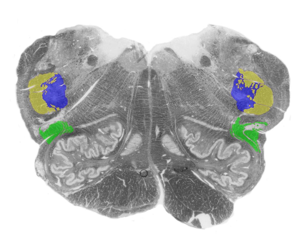 trigeminothalamic tract, as seen in cross-sections.