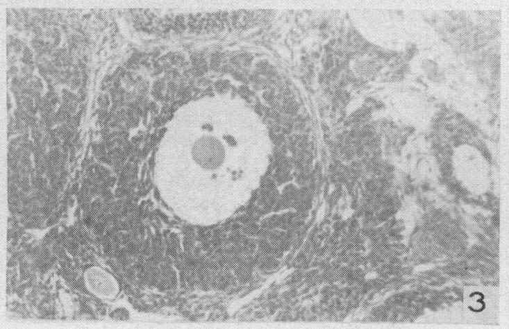 u. hcg. Intense luteinization has occurred entrapping the ovum.