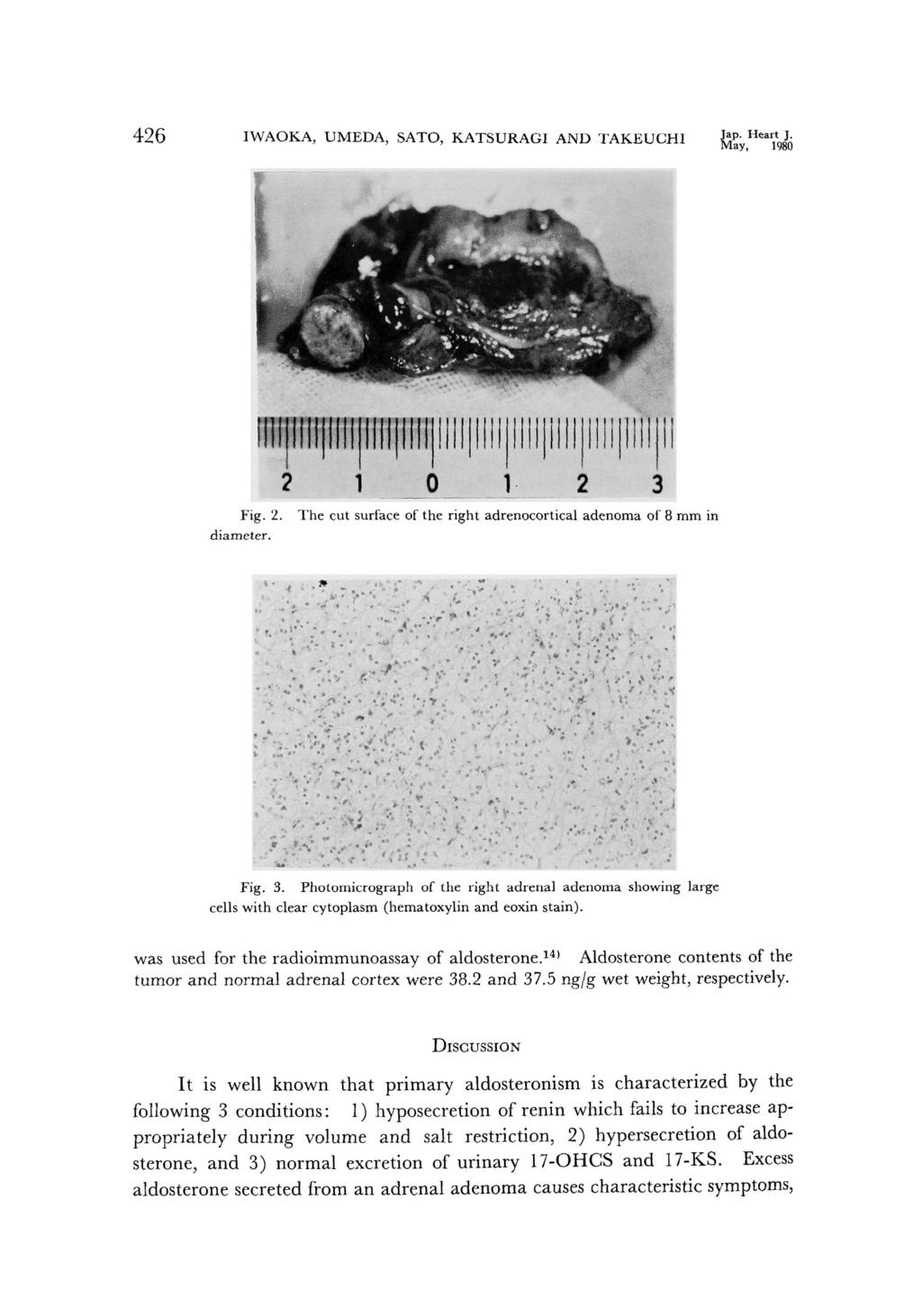 426 IWAOKA, UMEDA, SATO, KATSURAGI AND TAKEUCHI Jap. Heart J. M ay, 1980 Fig. 2. The cut surface of the right adrenocortical adenoma of 8mm in diameter. Fig. 3.