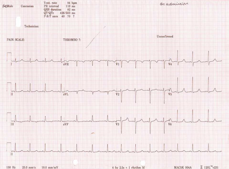 Measuring QT interval-ecg Effected by heart