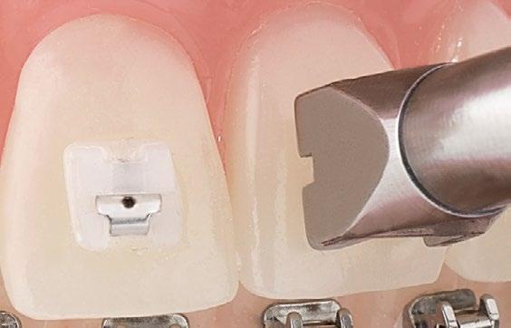 ) The only SL brackets with Pauls tool. Using Pauls tool, QuicKlear brackets can easily be removed without damaging either the bracket or the tooth enamel.