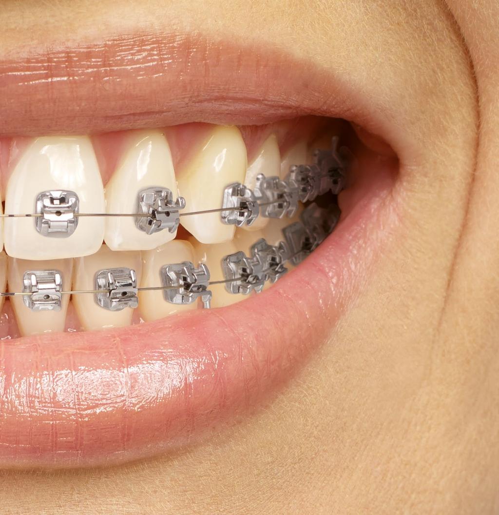 All Quick range brackets can be combined with one another perfectly, facilitating a visibly impressive aesthetic result for your patients in as quickly and comfortably a manner as possible.