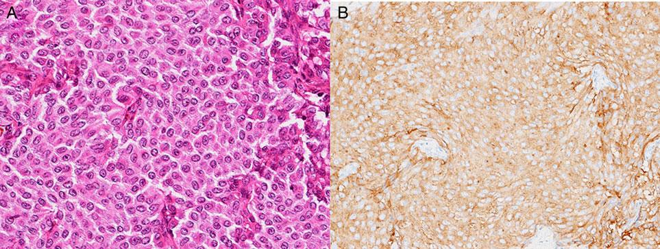 Jpn J Clin Oncol, 2015, Vol. 45, No. 4 331 Figure 1. Case 1: neuroendocrine carcinoma (NEC) of the maxillary sinus. (A) Hematoxylin and eosin (H&E) staining. (B) Synaptophysin. Figure 2.