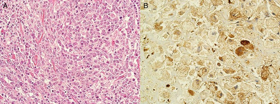 Case 5: squamous cell carcinoma with neuroendocrine features A 79-year-old man was diagnosed with a laryngeal tumor (ct3n2bm0) and underwent surgery.