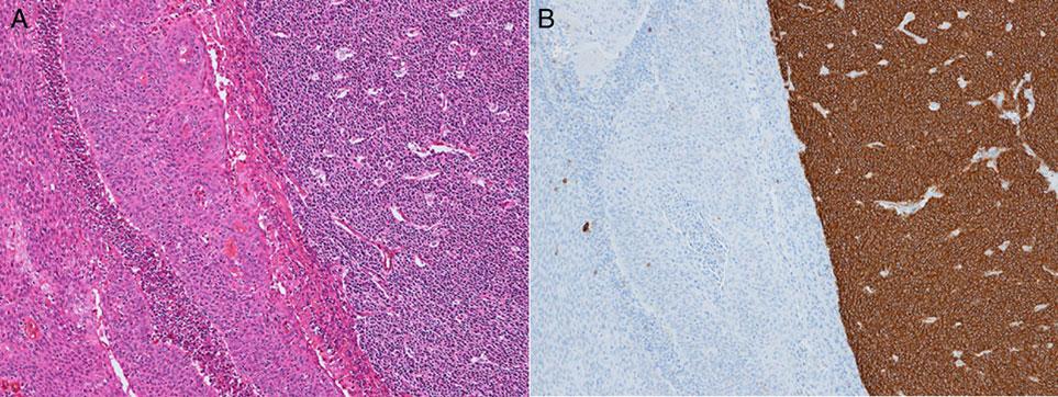 Figure 6. Case 6: metastatic spindle cell carcinoma with neuroendocrine features. (A) H&E staining. (B) CD56.